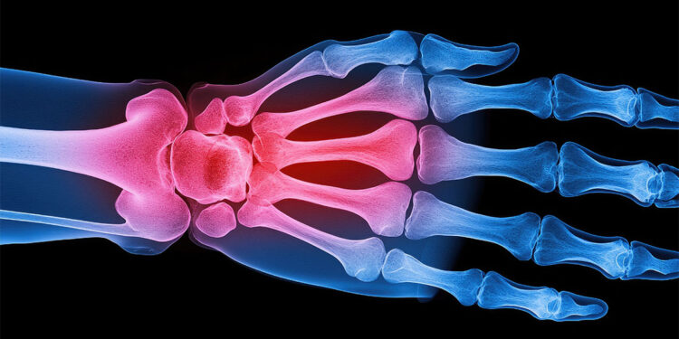 50 yaş üstündeki kişilerin dörtte birinde kemik erimesi saptandı