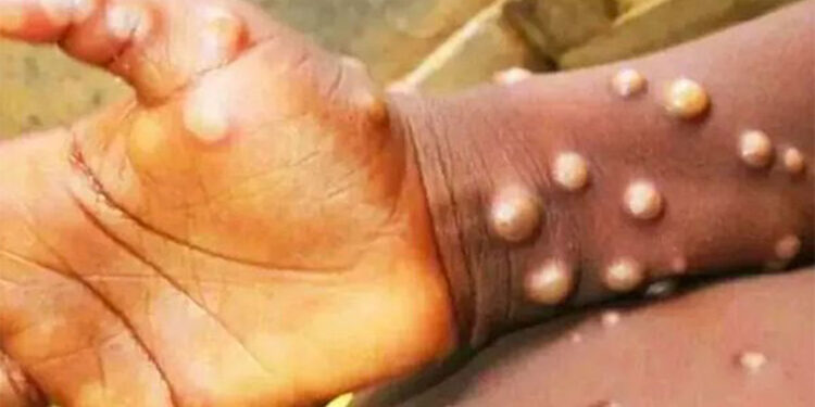 1980 öncesi doğanlar maymun çiçeğine karşı korunmalı