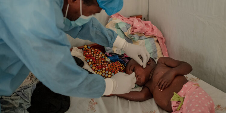 DSÖ'den maymun çiçeği alarmı