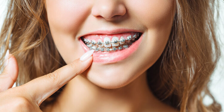 Şeffaf plaklar diş teli kaygısını ortadan kaldırıyor