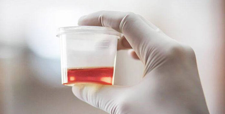 İdrarda kan görülmesi mesane kanserinin belirtisi olabilir