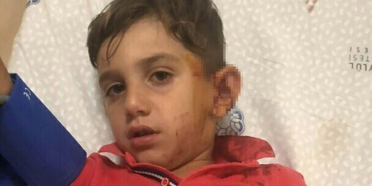 Sokak köpeğinin saldırısına uğrayan Baran yaralandı