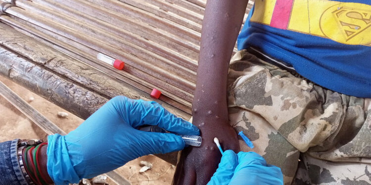 Maymun çiçeği virüsü çocuklar için çok tehlikeli