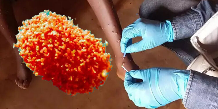 Maymun çiçeğine karşı aşı kampanyası başladı