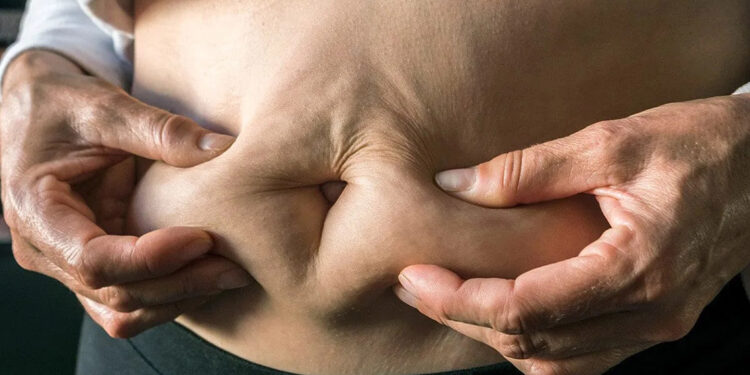 Obezite ameliyatlarından sonra görülen deri sarkması tedavi edilebilir