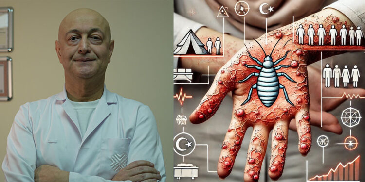 Uyuz vakalarındaki artışa dikkat