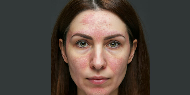 Kışın yüzünüzdeki kızarıklık için önemli ipuçları