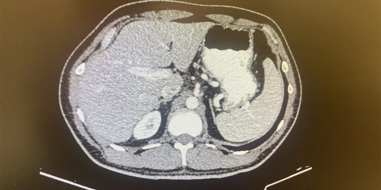 26 kadavra üzerinde mikroplastik araştırması