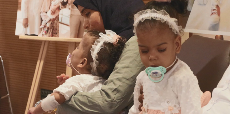 Cezayirli yapışık ikizler İstanbul'da 9 saatlik operasyonla ayrıldı