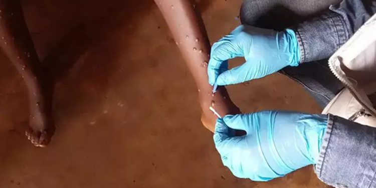 DSÖ, Maymun Çiçeği aşısına acil kullanım onayı verdi