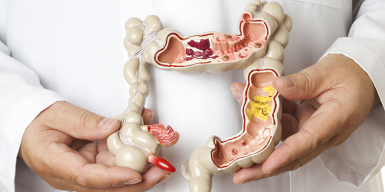 Kalın bağırsak kanserini yüzde 90 oranında önlemek mümkün