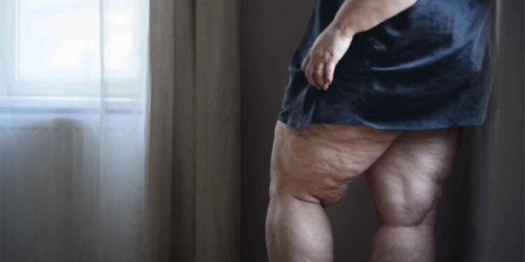 Lipödem'in tedavisi için hangi uzmanlara başvurulmalı?