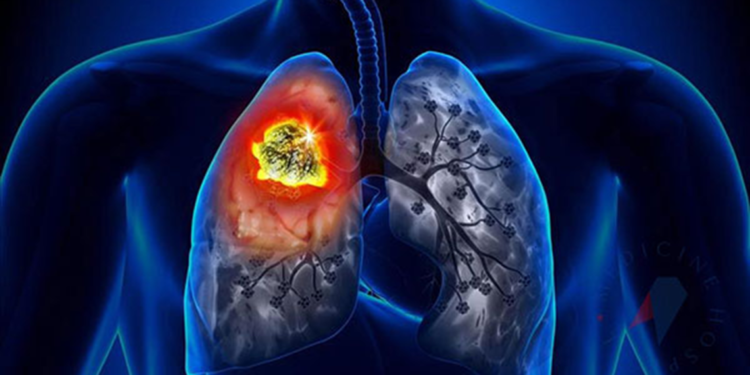 Son 1 yılda 31 bin kişi akciğer kanseri tanısı aldı