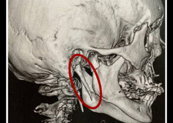 15 yıl çektiği boyun ağrısının nedeni, nadir görülen kemik uzaması çıktı