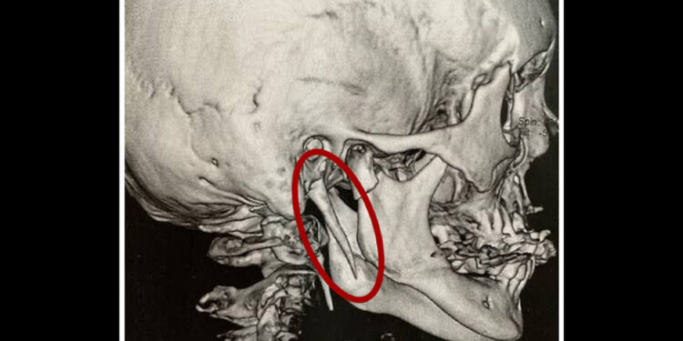 15 yıl çektiği boyun ağrısının nedeni, nadir görülen kemik uzaması çıktı