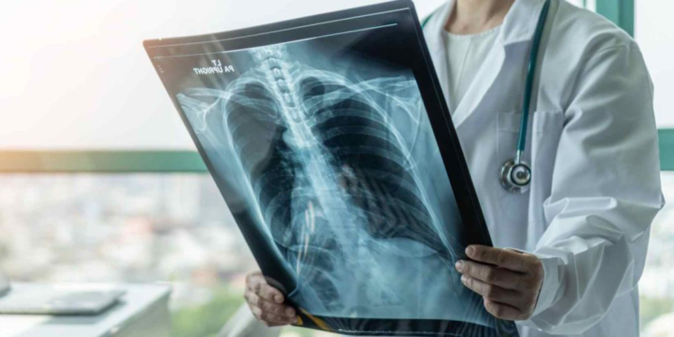 Akciğer kanserinin erken evrede tespit edilmesi hayat kurtarıyor