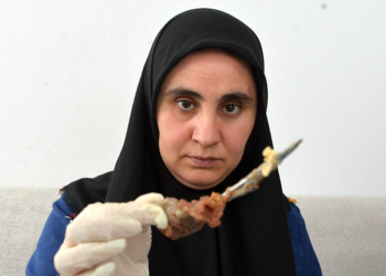 Ameliyatta karnında unutulan makas, 7 yıl sonra ortaya çıktı