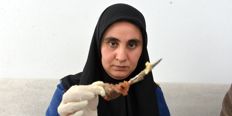 Ameliyatta karnında unutulan makas, 7 yıl sonra ortaya çıktı