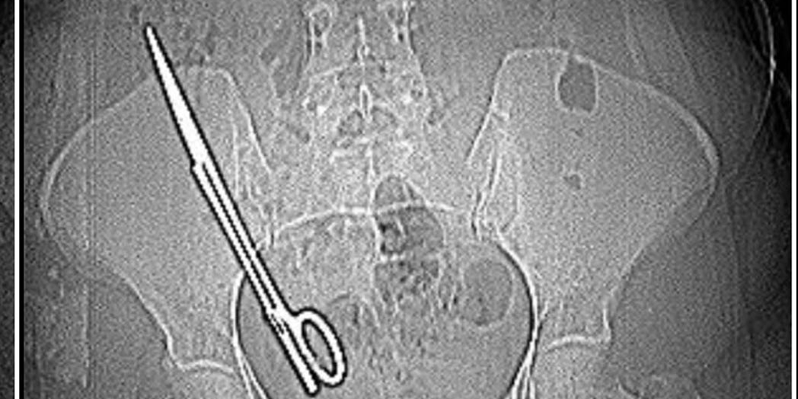 Ameliyatta karnında unutulan makas, 7 yıl sonra ortaya çıktı