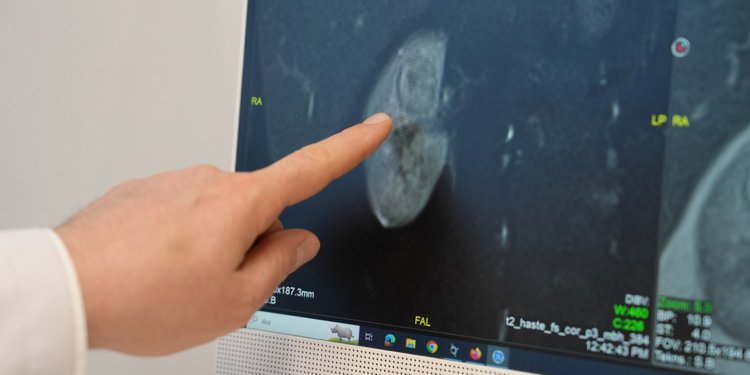 Böbrek kitlelerinde erken dönemde tedavi şansı artıyor