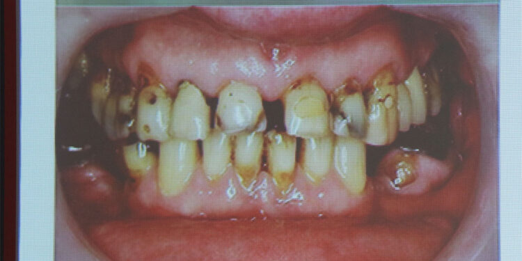 Ağız hijyeninde sınıfta kaldık; Aynı diş fırçasını 6 kişi kullandı