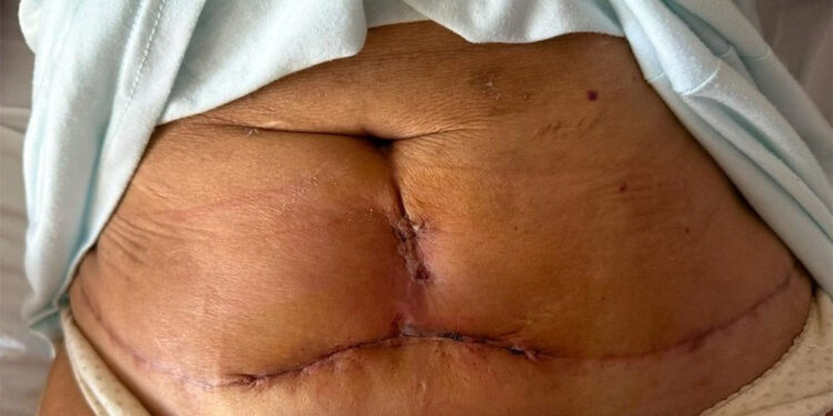 Karın ve kol germe ameliyatı oldu, dikiş izleri kaldı