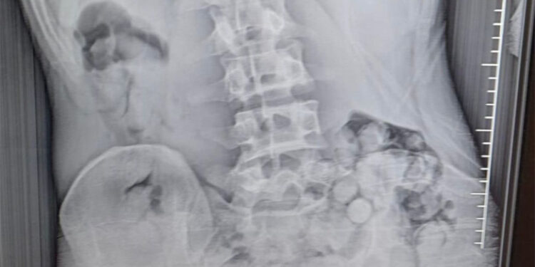 Midesinde 309 gram uyuşturucuyla yakalandı