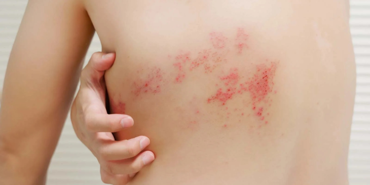 Zona riskine karşı rekombinant aşı