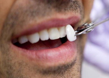 Diş estetiğinde yaprak porselenin popülerliği artıyor