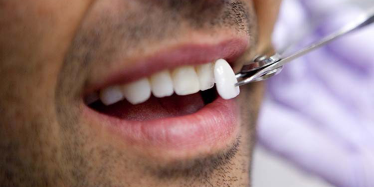 Diş estetiğinde yaprak porselenin popülerliği artıyor