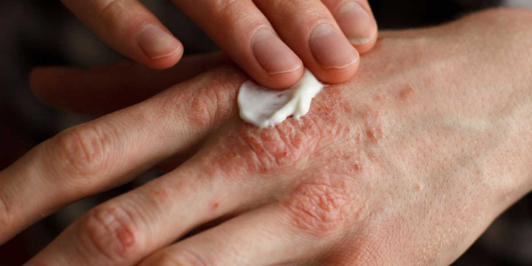 Egzama artık modern yöntemlerle tedavi edilebilir bir hastalık