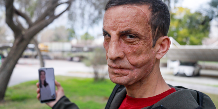 İlk yüz nakli yapılan Uğur'la duygulandıran görüşme