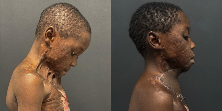 Oyun oynarken yanan Kamerunlu çocuk, sağlığına kavuştu