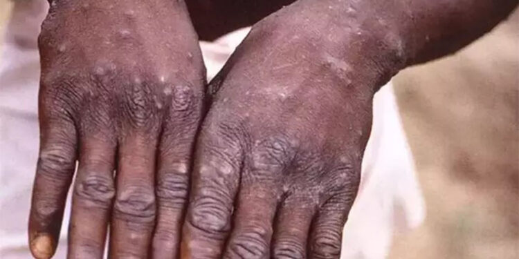 Maymun çiçeği vakaları nedeniyle ‘acil durum’ ilan edildi