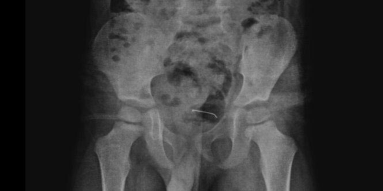 5 yaşındaki çocuğun yuttuğu toplu iğne, ameliyatla çıkarıldı