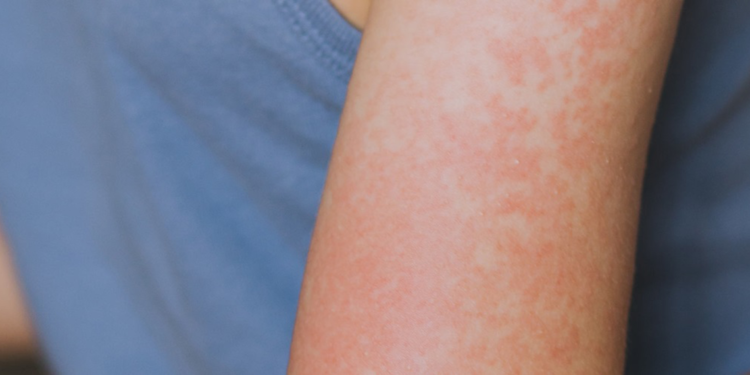 ABD'nin Teksas eyaletinde 48 kızamık vakası bildirildi