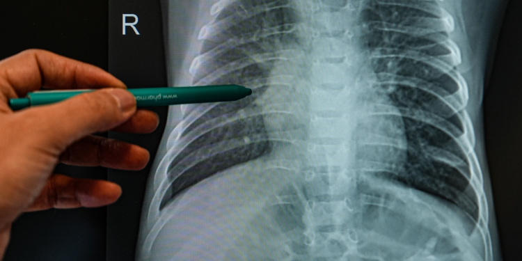 Alerjik çocuklarda enfeksiyon riski daha yüksek