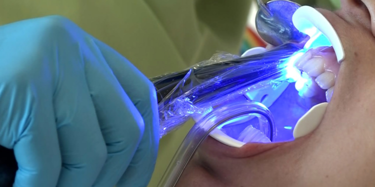 Beyazlatma işleminde yanlış uygulama diş kaybına neden olabilir