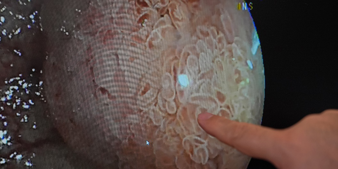 Diz ve kalça ağrısıyla gitti, bağırsak kanserinden kurtuldu