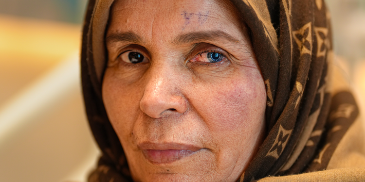 Kornea nakli geçiren kadın, iki farklı göz rengine sahip oldu