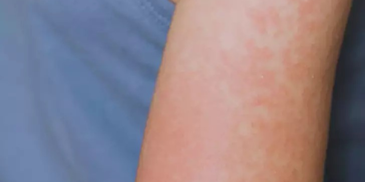 ABD'deki kızamık salgınında vaka sayısı 223'e yükseldi