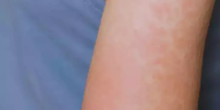 ABD’nin Kansas eyaletinde 23 kızamık vakası bildirildi