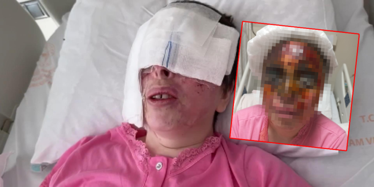 Avcılar'da yüzüne kezzap atılan kadın: En büyük cezayı alsın 