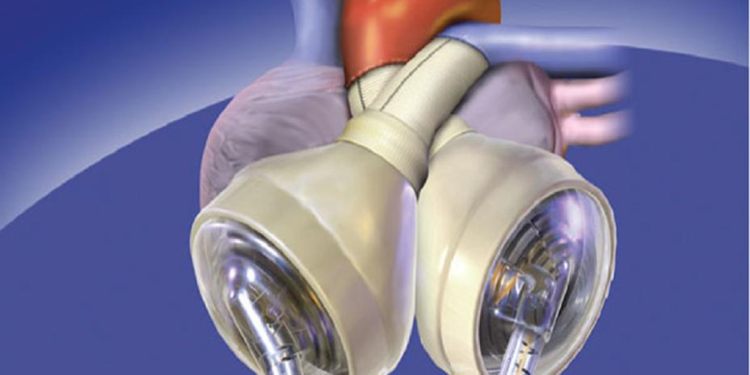 Avustralyalı hasta yapay kalple 100 gün hayatta kaldı