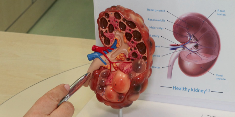 Böbrek hastalıkları sessizce ilerliyor: Erken teşhis hayat kurtarıyor