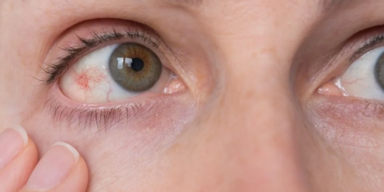 Glokom öyküsü olan kişiler dikkat; Uzmanı uyardı