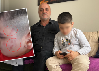 Otizmli öğrencinin vücudundaki morluklara soruşturma