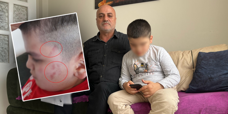 Otizmli öğrencinin vücudundaki morluklara soruşturma