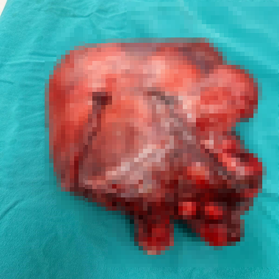 Rahminden 35 santimlik miyom çıktı