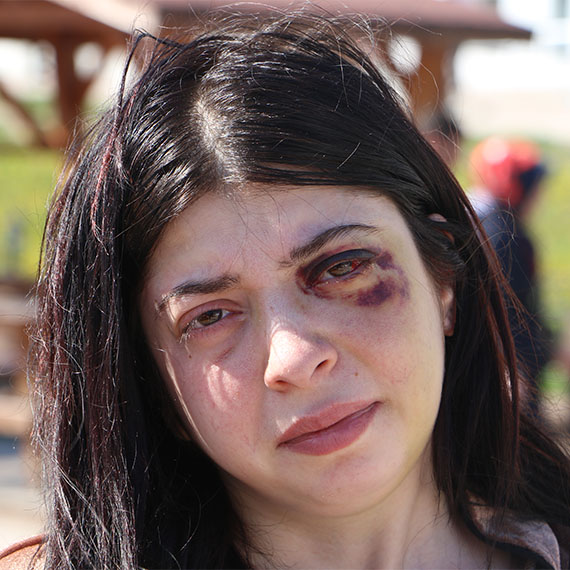 Samsun’un Atakum ilçesinde sokak ortasında darbedilen Damla Korkmaz, 8 gün süren tedavisinin ardından taburcu edildi.